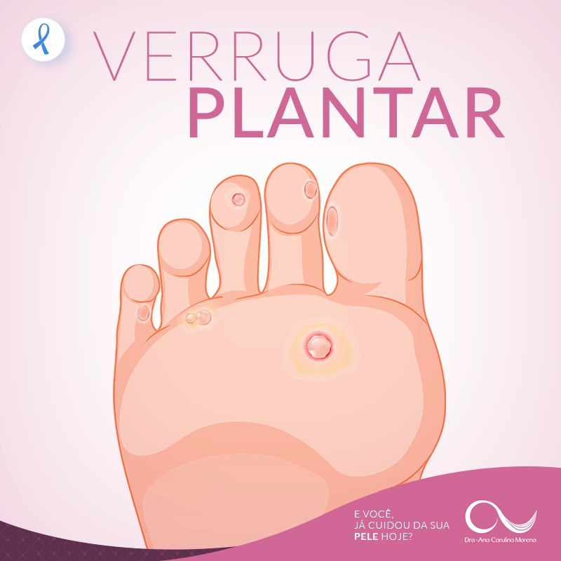 verruga plantar