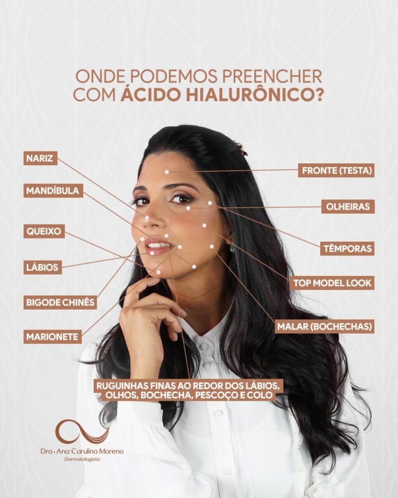 Preenchimento facial com ácido hialurônico