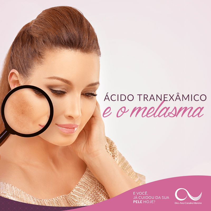 Tratamentos para Melasma recreio dos bandeirantes