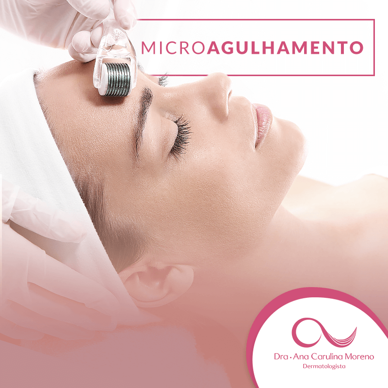 microagulhamento no recreio
