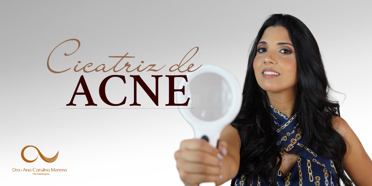 Cicatriz de Acne