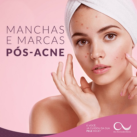 dermatologista especialista em acne