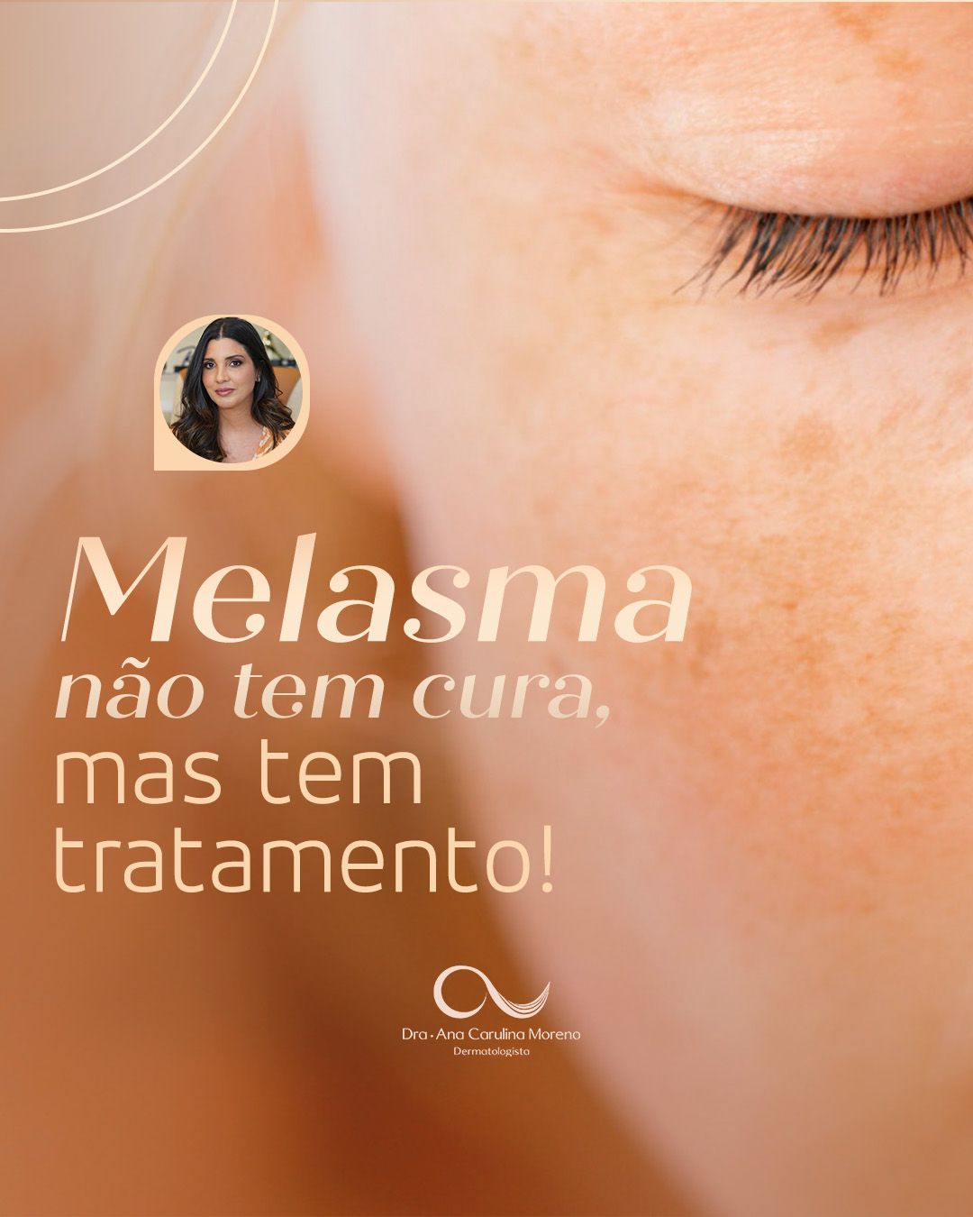 melasma