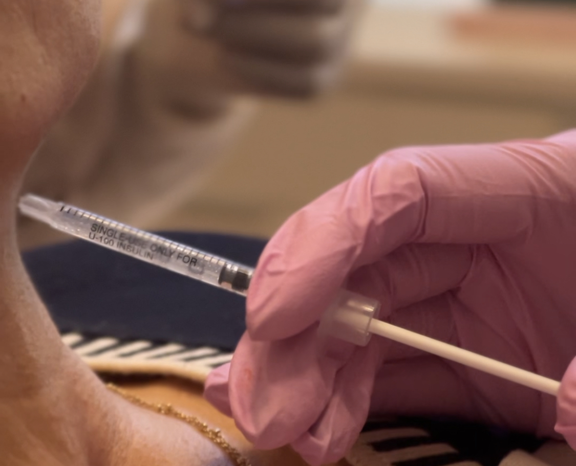 Lipo de Papada no RJ