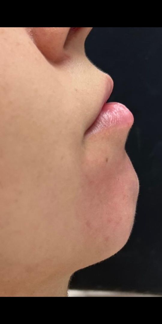 Perfil de queixo retraído antes do tratamento