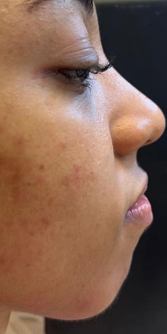 Perfis comparativos antes do preenchimento do queixo