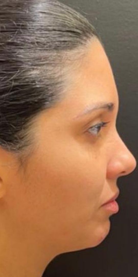 Perfil antes do preenchimento de queixo