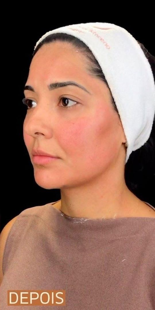 Sculptra Antes e Depois