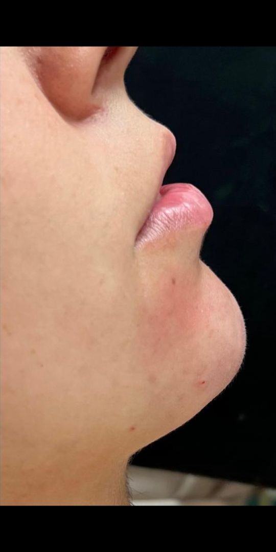 Perfil mais harmônico após preenchimento do mento