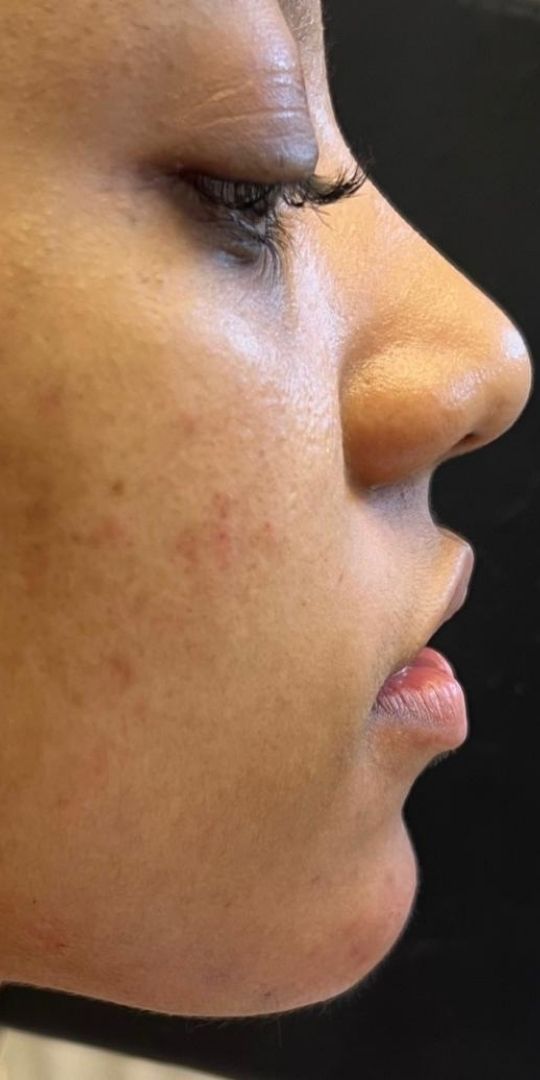 Antes e depois de Preenchimento do Queixo no RJ