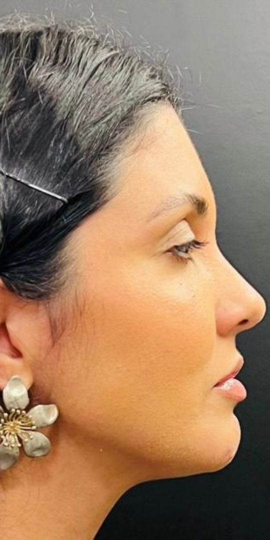 Resultado após preenchimento de queixo com ácido hialurônico