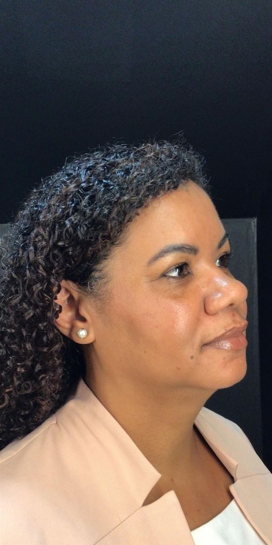 Sculptra Antes e Depois