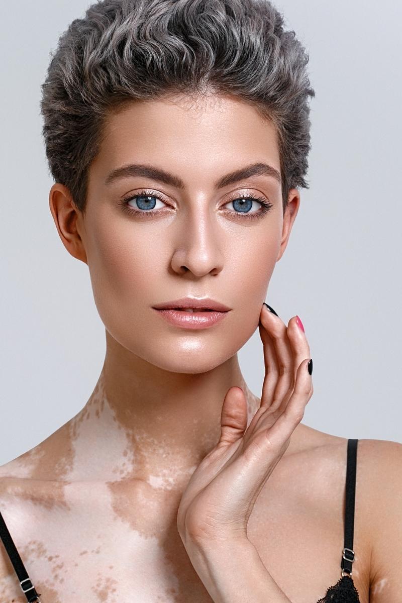 Vitiligo e psoríase a laser