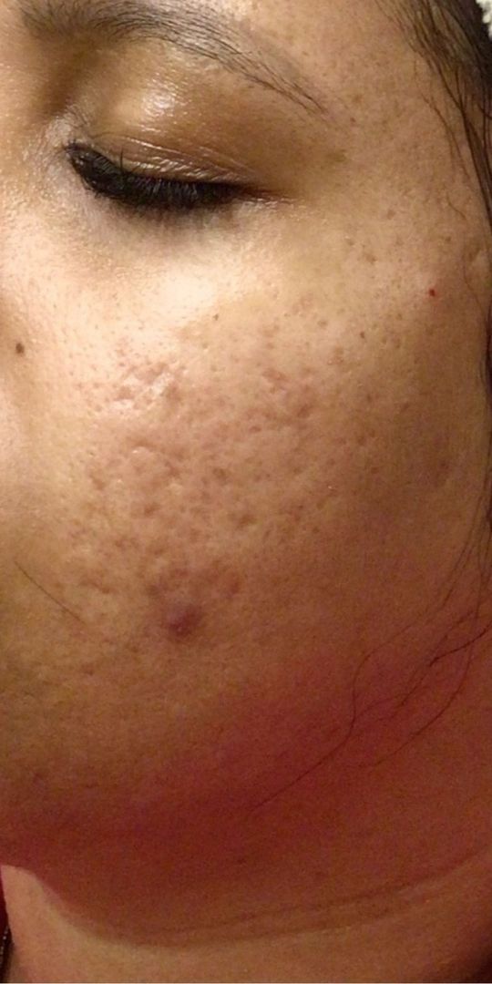 Roacutan Antes e Depois