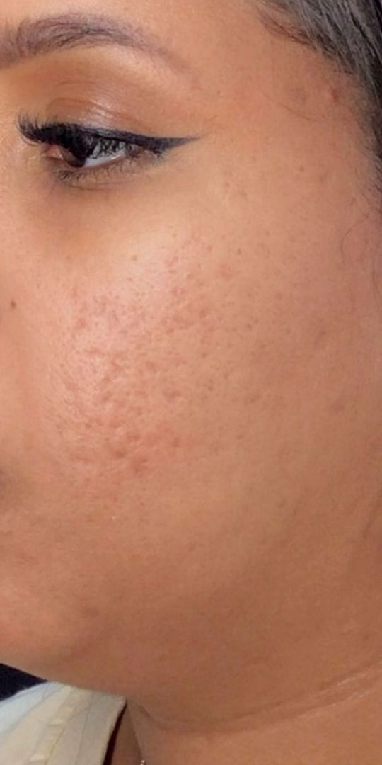 Roacutan Antes e Depois