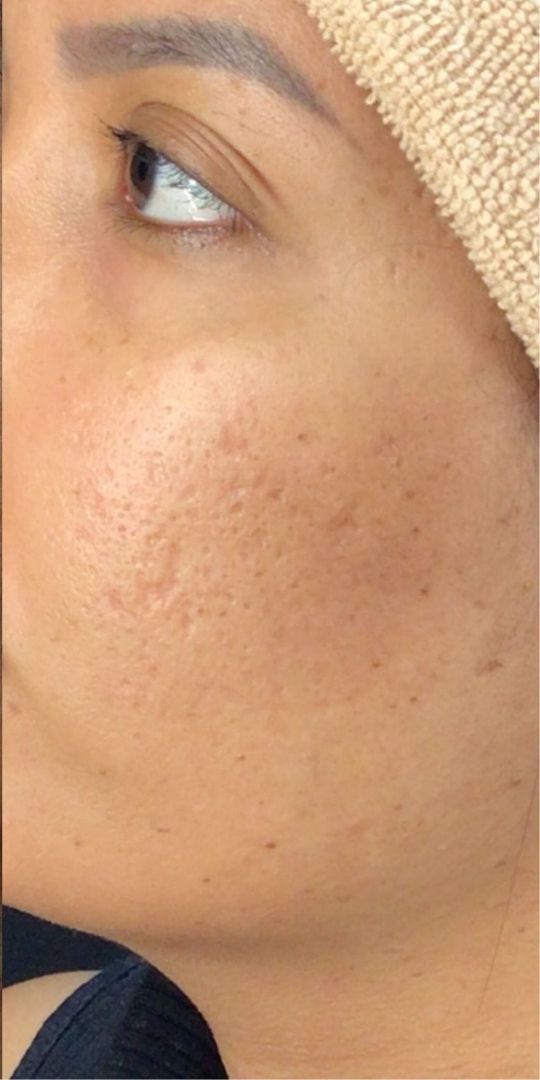 Roacutan Antes e Depois