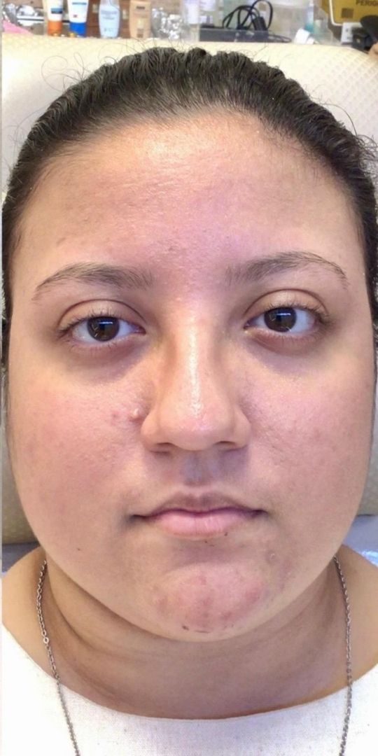 Roacutan Antes e Depois