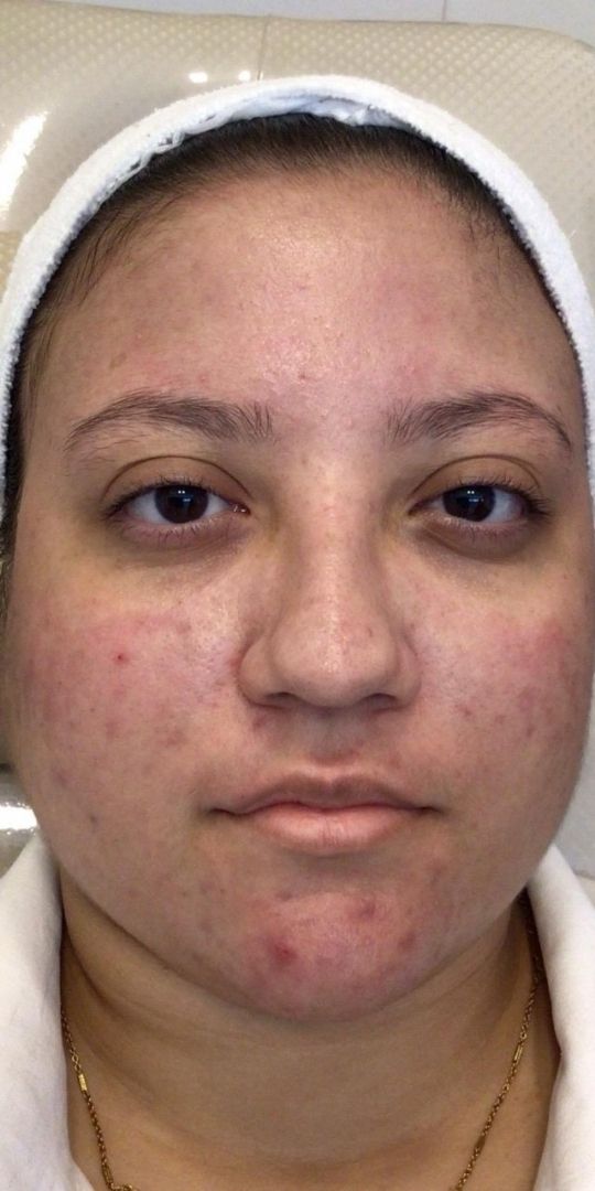 Roacutan Antes e Depois