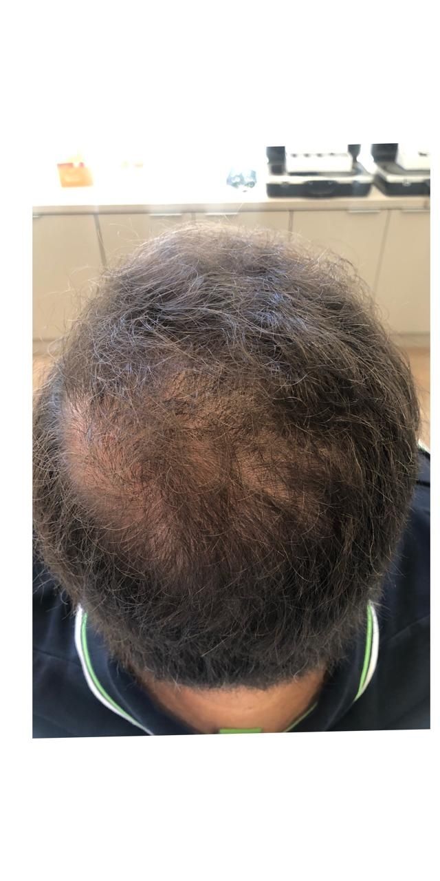 Queda de Cabelo Antes e Depois