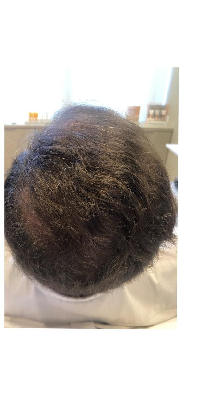 Queda de Cabelo Antes e Depois