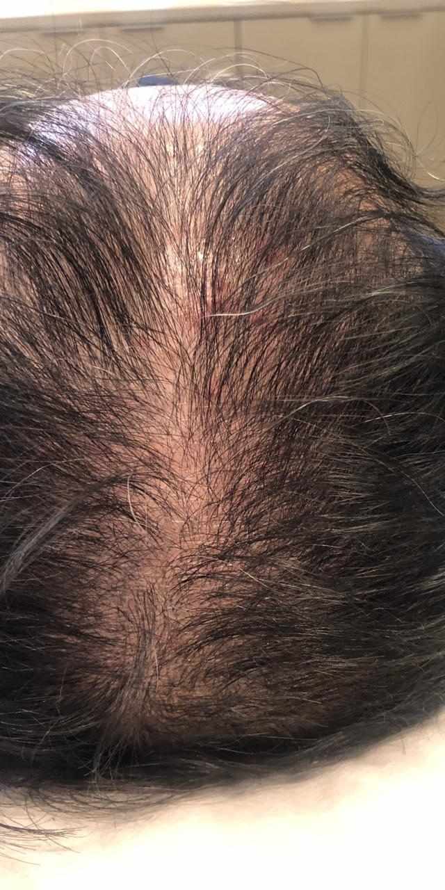 Queda de Cabelo Antes e Depois