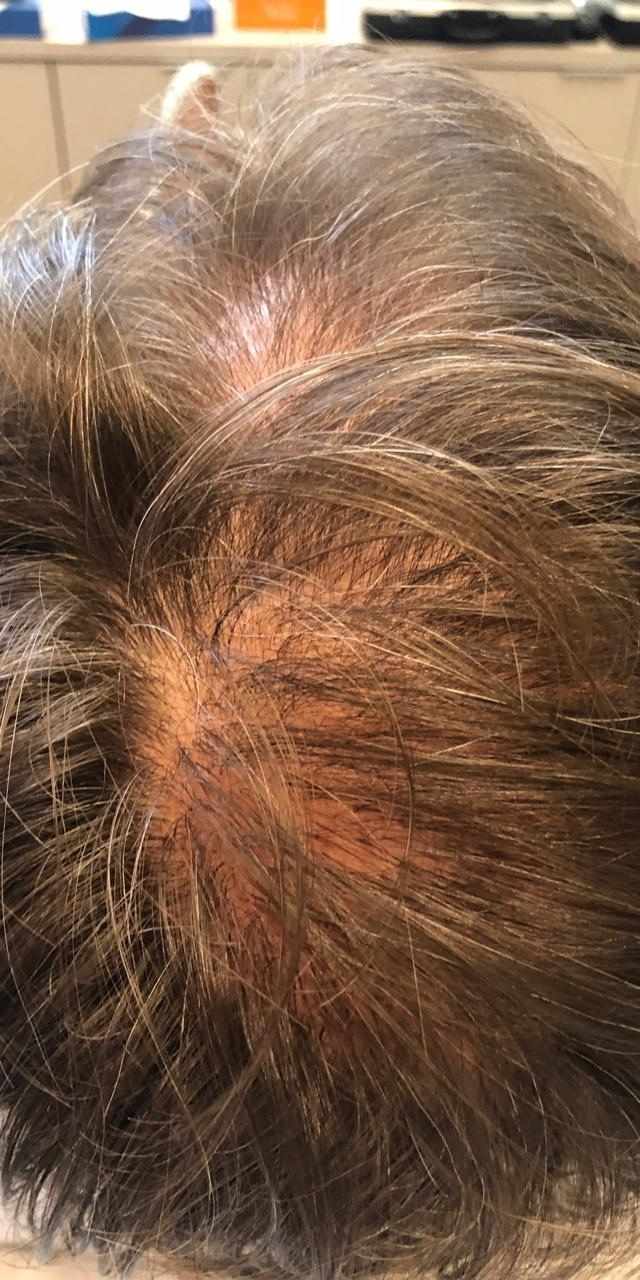Queda de Cabelo Antes e Depois