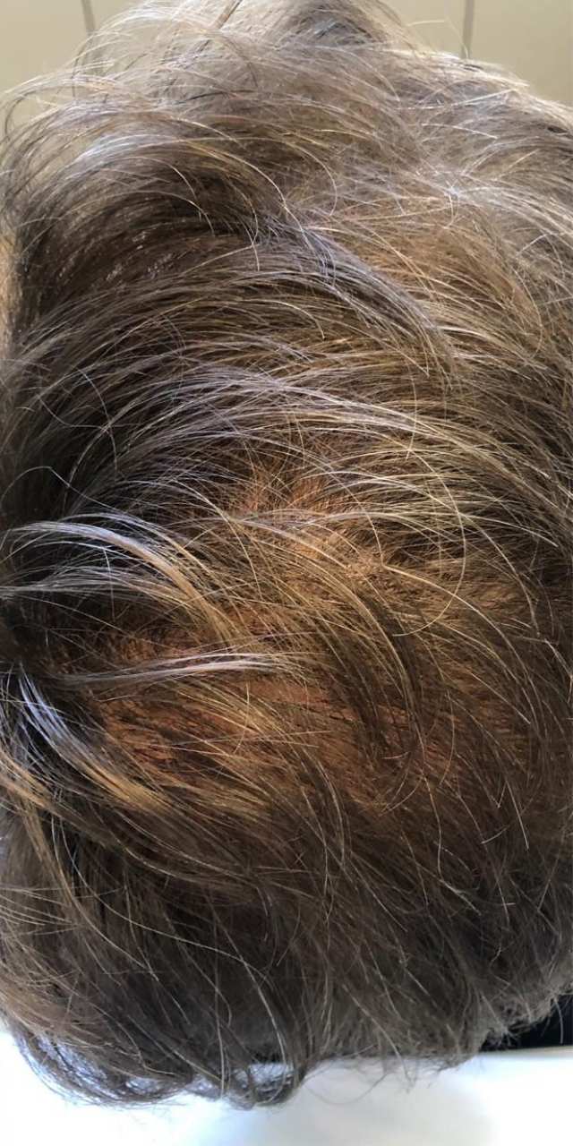 Queda de Cabelo Antes e Depois