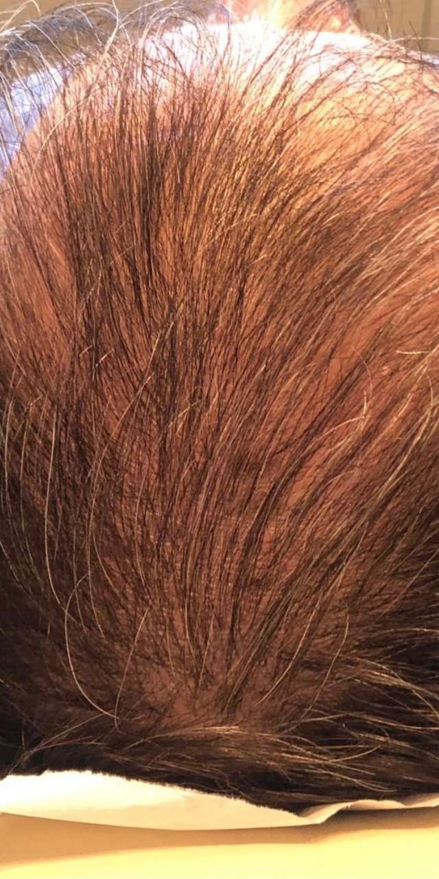 Queda de Cabelo Antes e Depois
