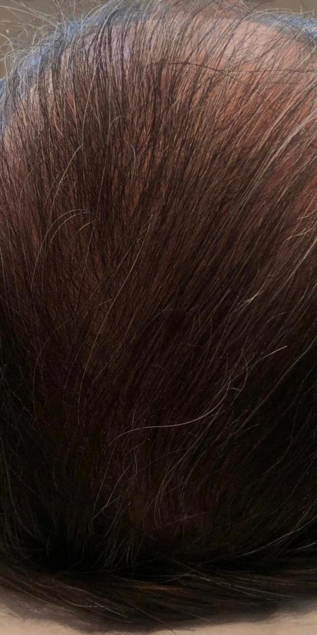 Queda de Cabelo Antes e Depois