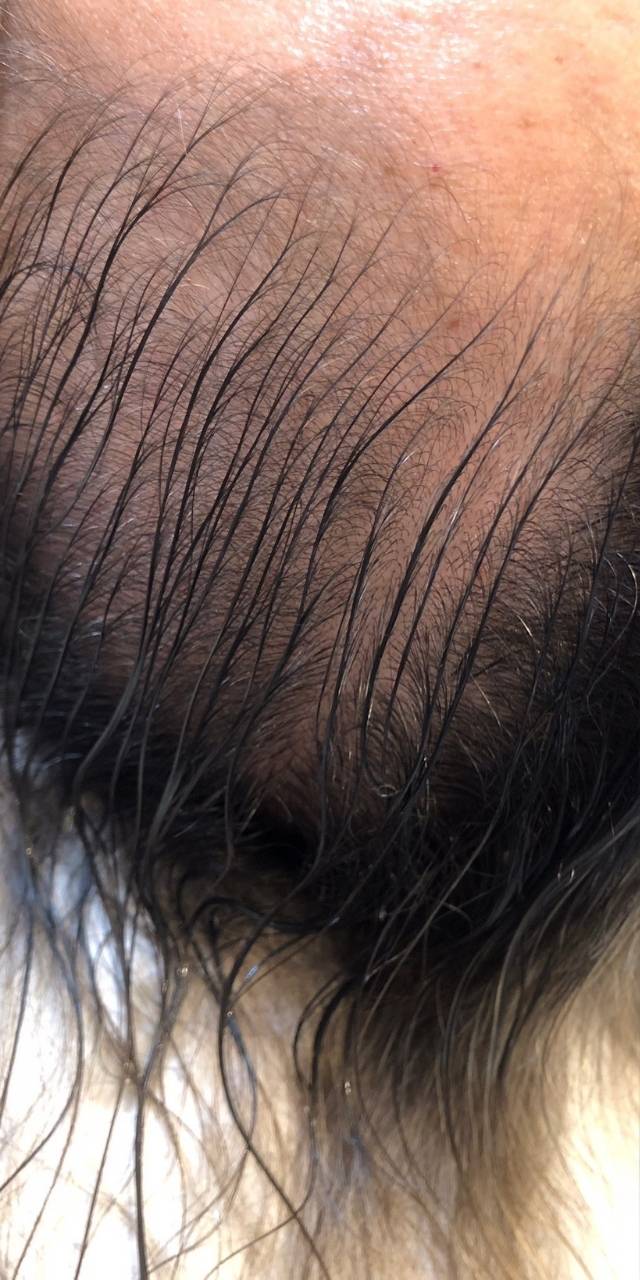 Queda de Cabelo Antes e Depois