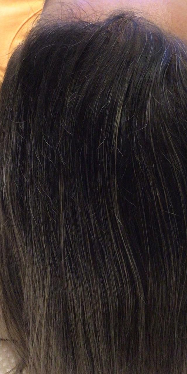 Queda de Cabelo Antes e Depois