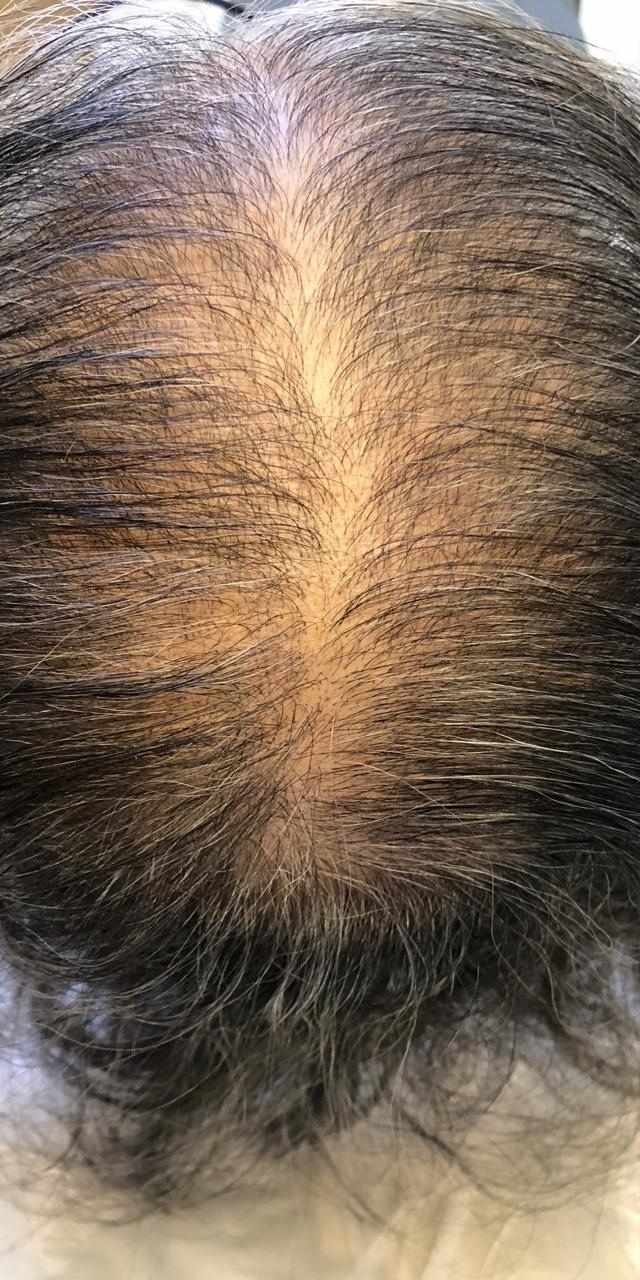 Queda de Cabelo Antes e Depois