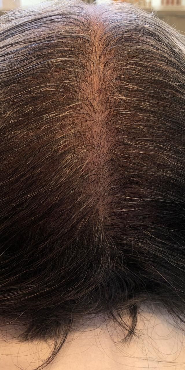 Queda de Cabelo Antes e Depois