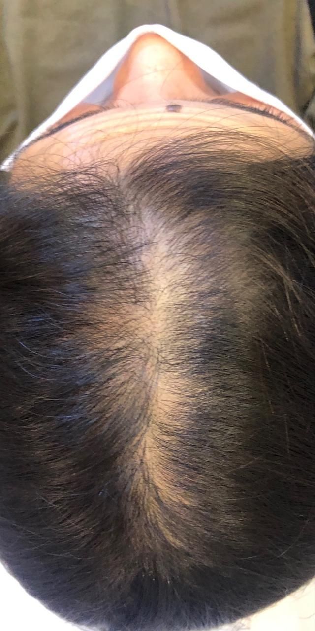 Queda de Cabelo Antes e Depois
