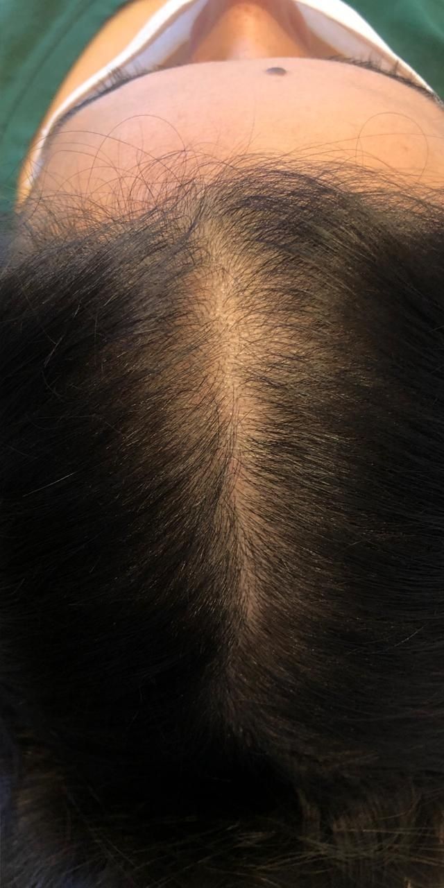 Queda de Cabelo Antes e Depois
