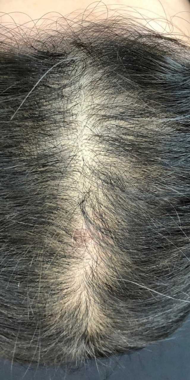 Queda de Cabelo Antes e Depois