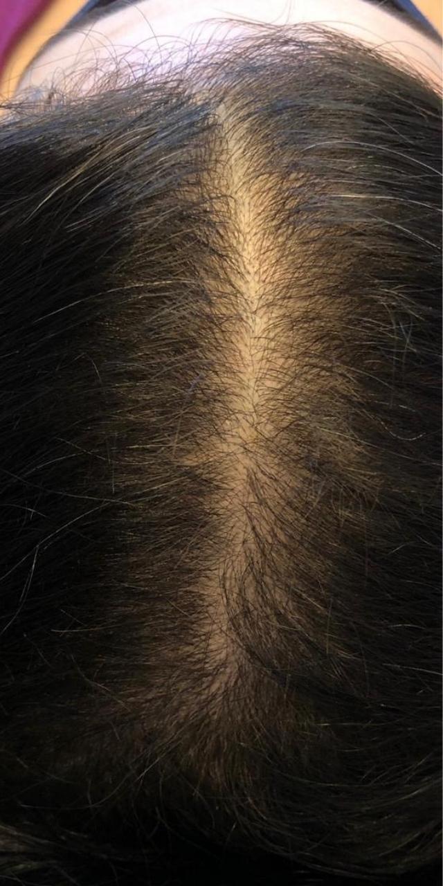 Queda de Cabelo Antes e Depois