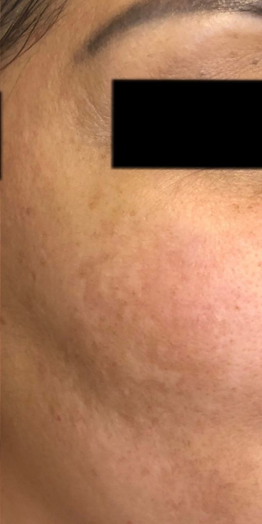 Manchas na Pele Antes e Depois