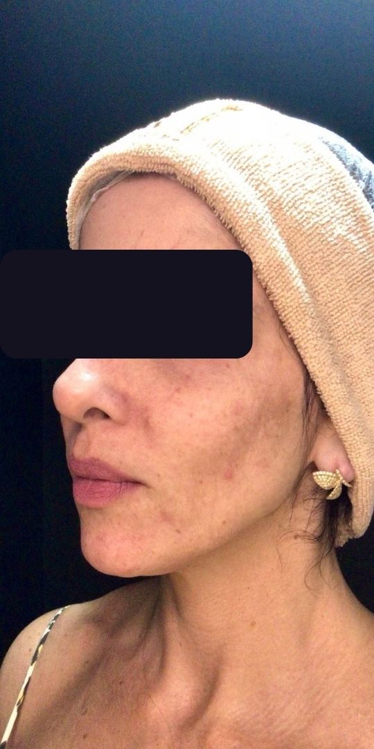 Manchas na Pele Antes e Depois