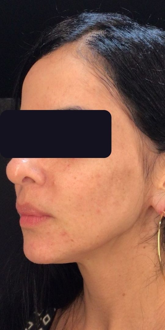 Manchas na Pele Antes e Depois