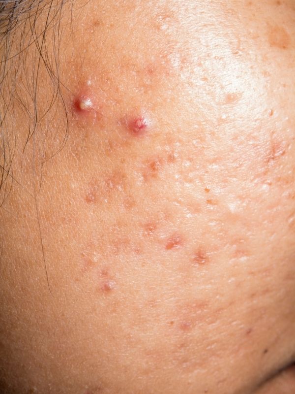 Rosto e acne infectada