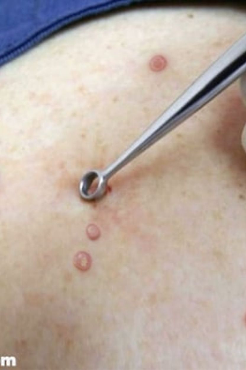 Curetagem de verruga