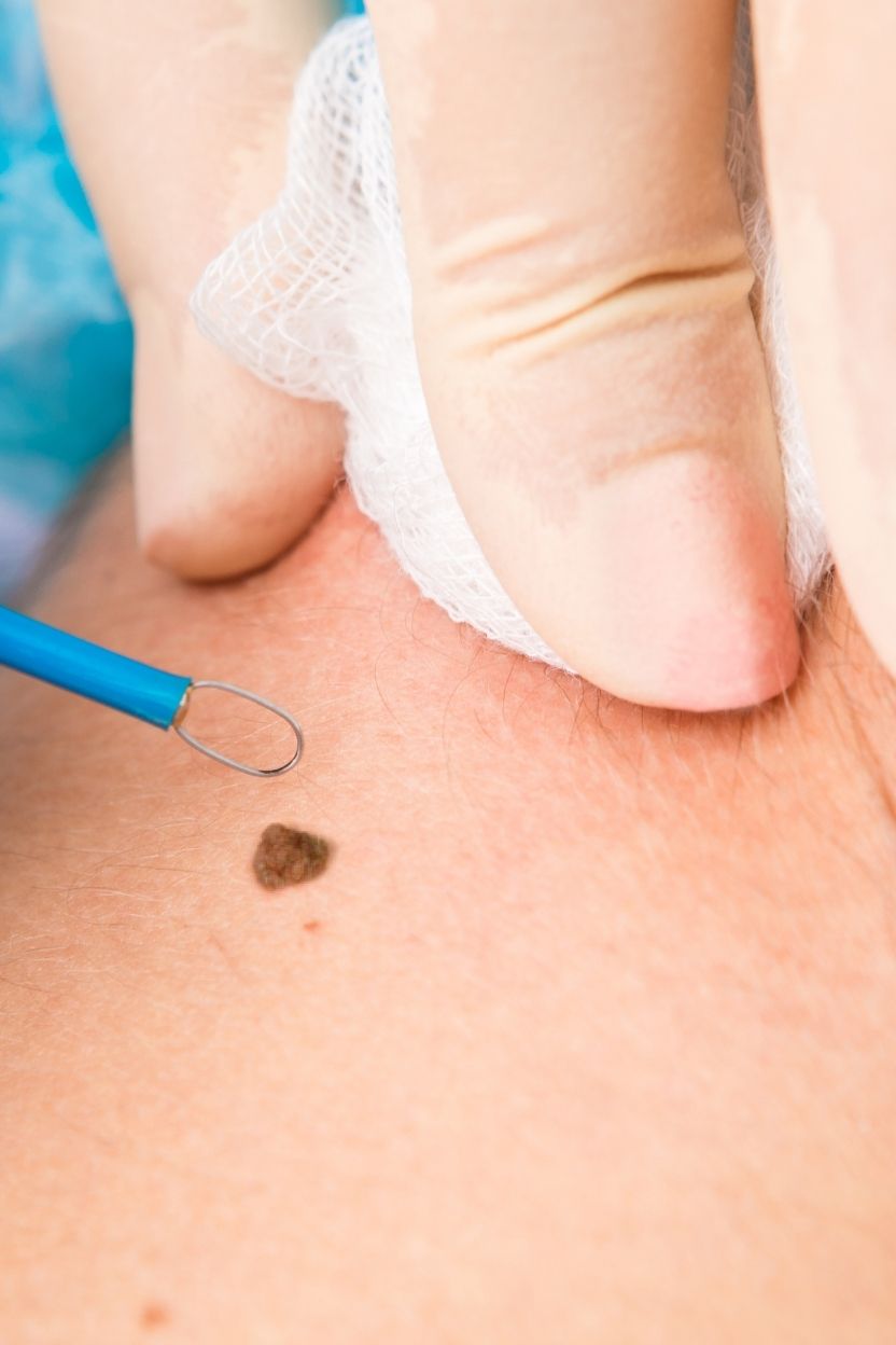 Eletrocoagulação ou cauterização de verruga