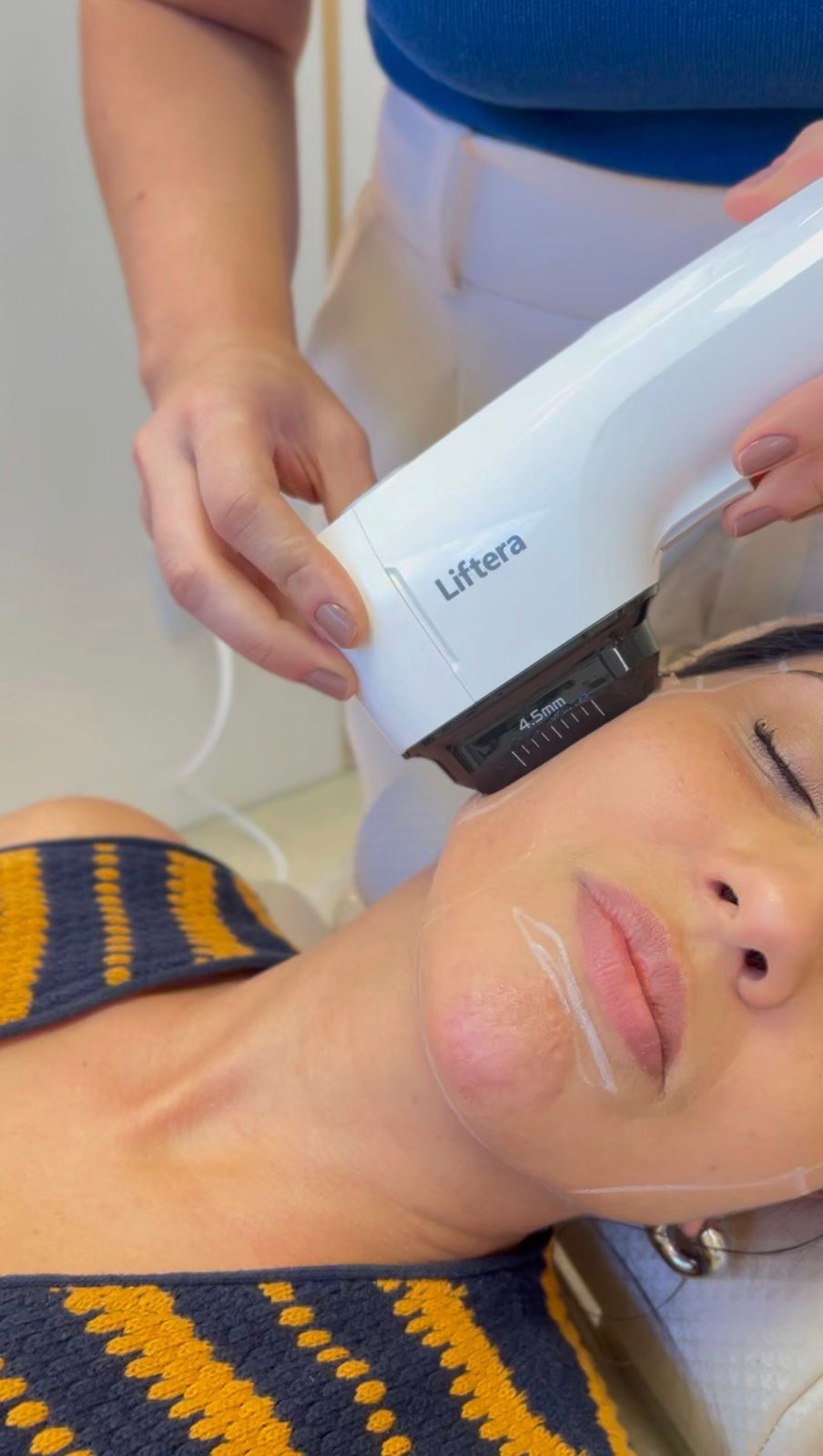 Tecnologias para retração de pele na região do queixo